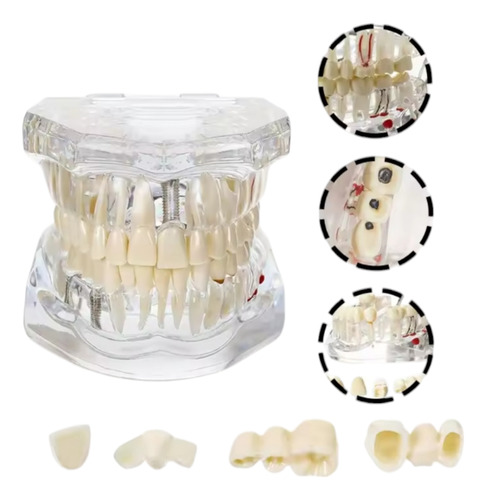 Maqueta Didáctica De Patologías Y Tratamientos Dental