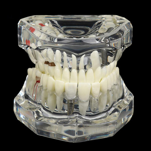 Maqueta Didáctica De Patologías Y Tratamientos Dental